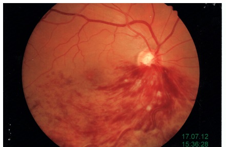 Occlusione emiciclica retinica risolta spontaneamente